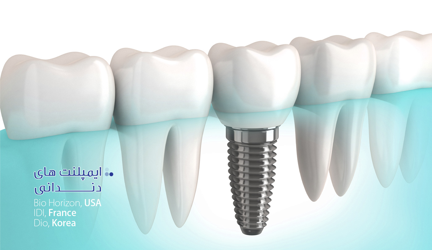ایمپلنت دندانی دکتر پورصادق