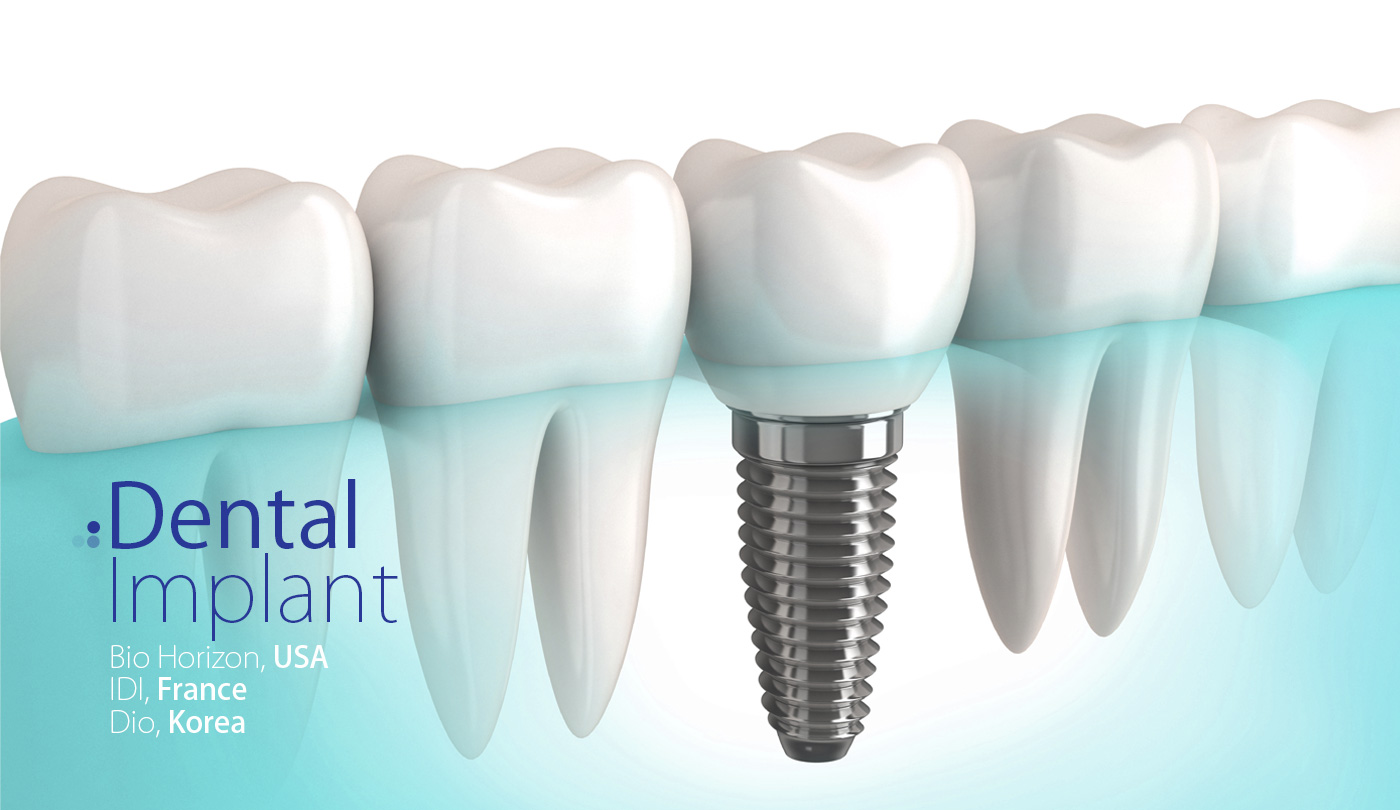 Dental-Implant